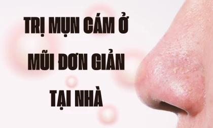 Trị Mụn Cám Ở Mũi Đơn Giản Tại Nhà